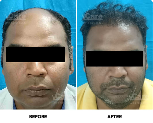 Graft-implantation-process